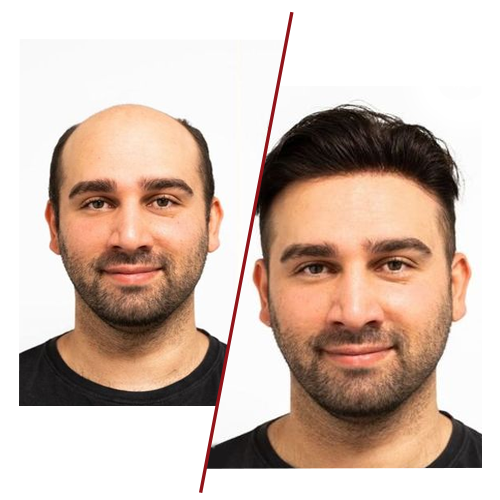 “Hair bonding procedure step by step at Infiniti Hair Club”