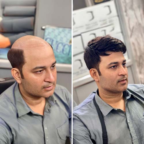 Hair Extensions Service in Mumbai for Men