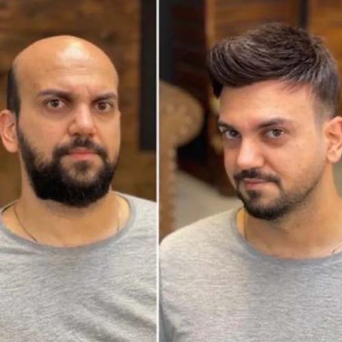 Synthetic Hair Wigs in Mumbai for men