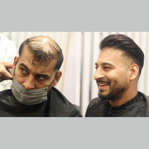 Clip on Hair System for Men
