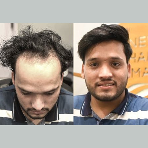 Hair pieces for Men